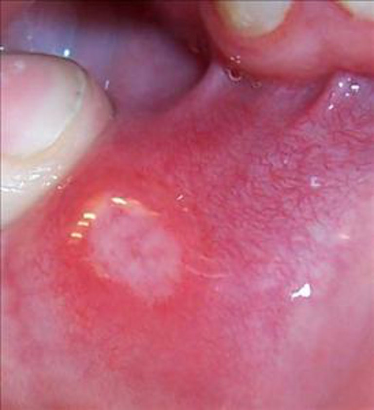 Mouth Sores and Celiac Disease