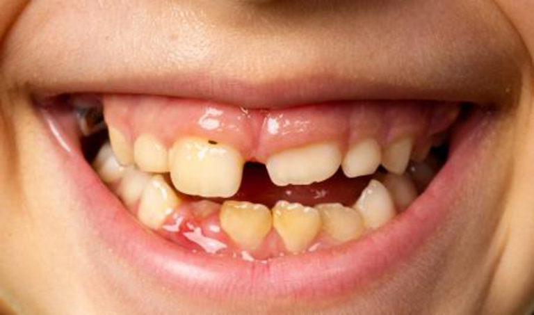 Effects of Celiac Disease on Tooth Development